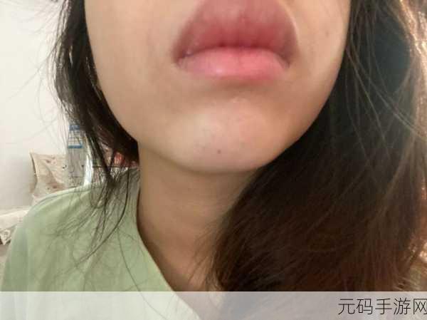 上下两张嘴都肿了：1. ＂双唇肿胀，暗藏健康隐患与生活困扰